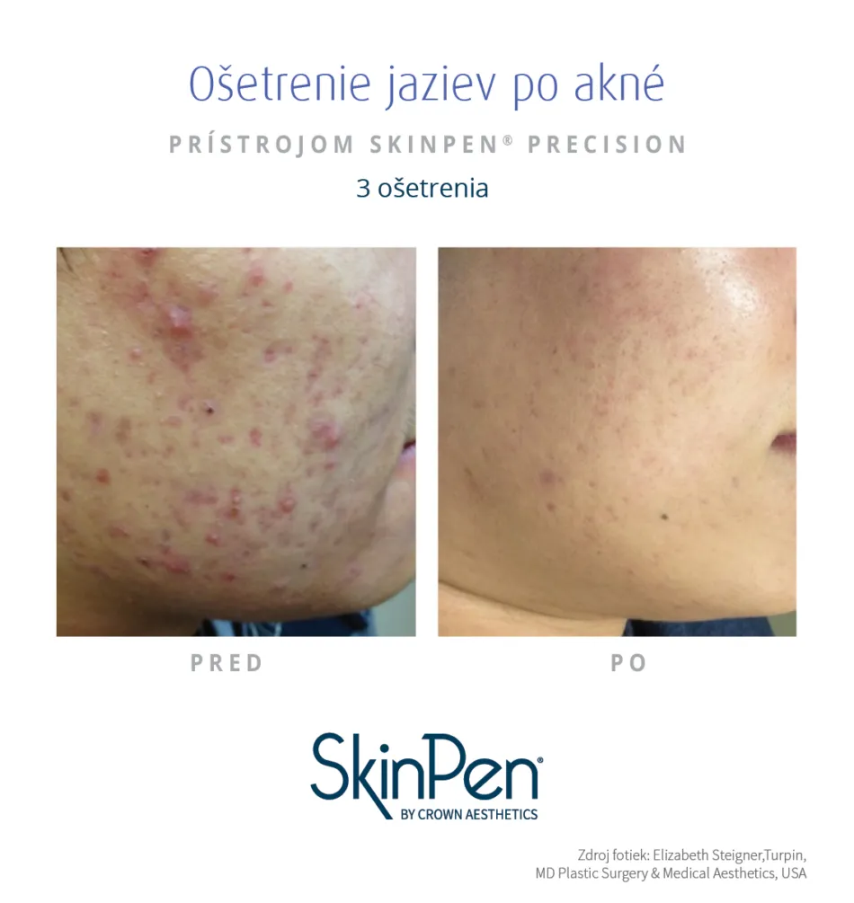 Skin Pen vysledky osetrenia Jazvy po akne 3