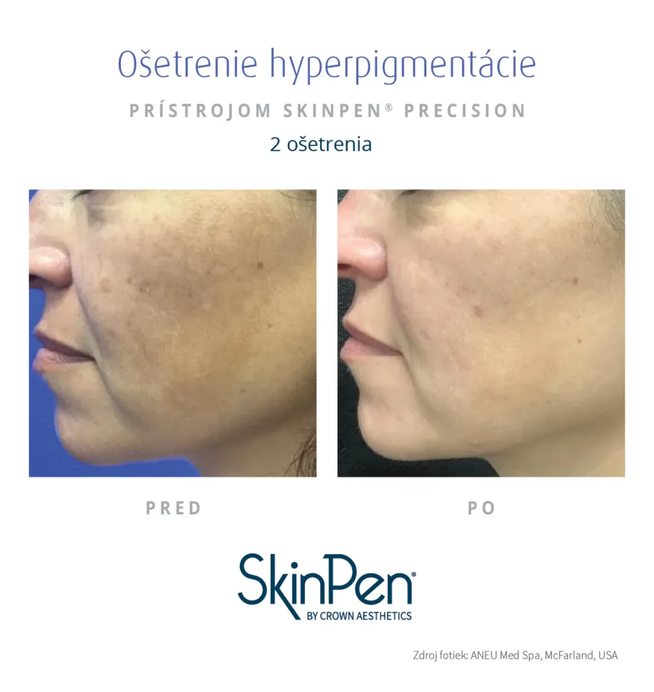 Skin Pen vysledky osetrenia pigmentacie
